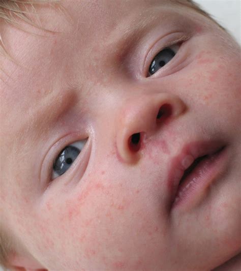 Allergic Reaction Rash Baby
