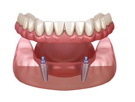 Implant Retained Dentures Hq Dental Leeds Uk