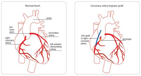 Coronary Artery Bypass Graft Surgery Heart Foundation