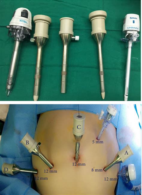 Retziussparing Robotassisted Radical Prostatectomy Using The Revoi Robotic Surgical System