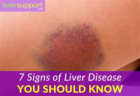 Symptoms Of Liver Disease You Should Know Artofit