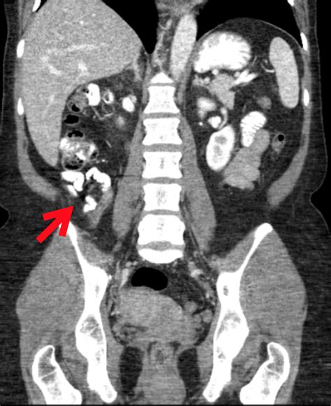 Cureus Incidental Finding Of Diverticulosis Of The Appendix With