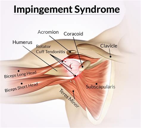 Shoulder Impingement Syndrome Local Physio Local Physio