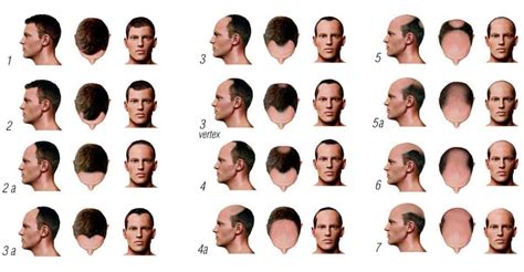 34 Haircut For Male Pattern Baldness Conanshoucheng