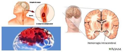 Hemorragia Cerebral Qu Es Causas S Ntomas Diagn Stico