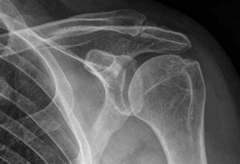 Acromioclavicular Joint X Ray