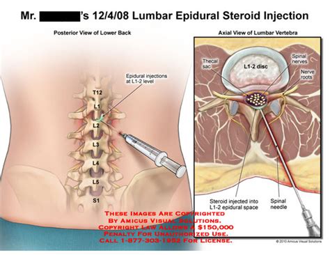 AMICUS Illustration Of Amicus Medical Lumbar Epidural Spine Steroid Injections L Level Thecal