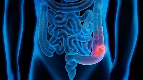 Three Drugs Top Two For Braf Metastatic Colorectal Cancer Medpage Today