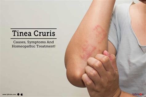 tinea cruris causes symptoms and homeopathic treatment by dr sandeep sarao lybrate