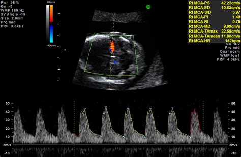 Middle Cerebral Artery Doppler For Fetal Anemia Department Of