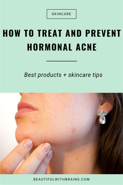 The Ultimate Guide To Dealing With Hormonal Acne