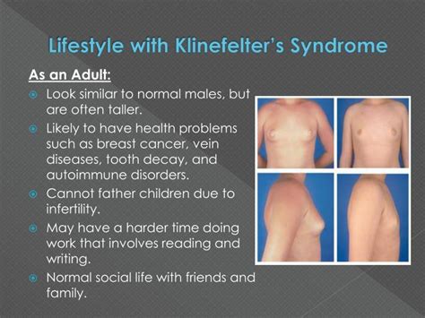 klinefelter syndrome as related to androgen insensitivity syndrome pictures