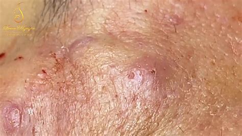 Infected Sebaceous Cyst Removal Under Local Anesthesia Dezireclinic