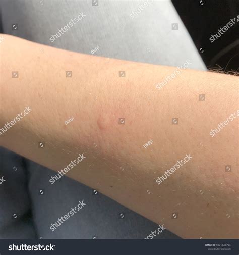 Allergic Reaction Mosquitoes Bites Arm Stock Photo 1021442794