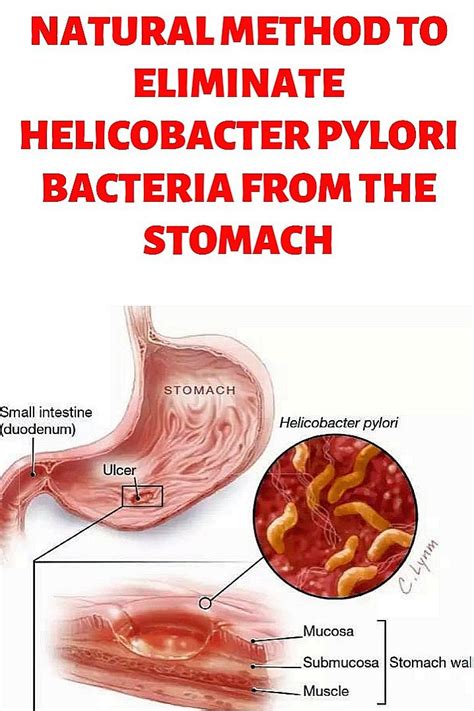 Stomach Ulcers Infection With H Pylori Symptoms Natural Treatments
