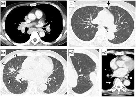 Chest Ct Scans Of Igg4 Rrd Showing A Mediastinal Lymphadenopathy