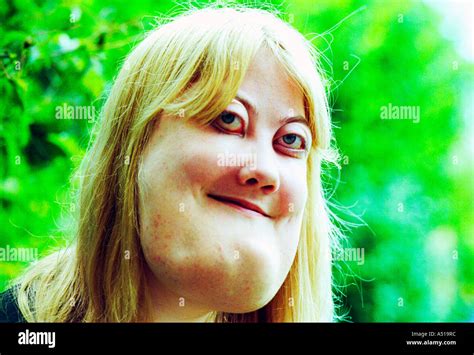 A Young Woman With Cherubism The Rare Genetic Condition Is A Stock