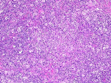 Pathology Outlines Histiocytic Tumors