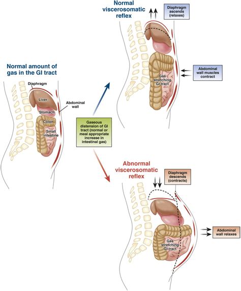 Management Of Chronic Abdominal Distension And Bloating Clinical