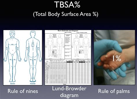 Part Ii Tbsa Assessment And Burn Apps Closing The Gap