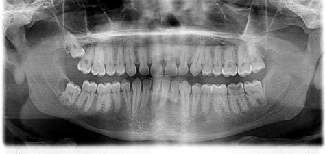 Find great deals on ebay for dental xray digital. Are dental X-rays necessary? - Spodak Dental Group