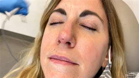 Removing A Small Bump On The Nose Fibrous Papule Youtube