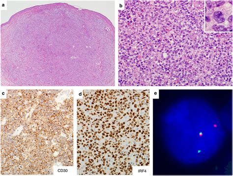 Representative Case Of Primary Cutaneous Anaplastic Large Cell Lymphoma