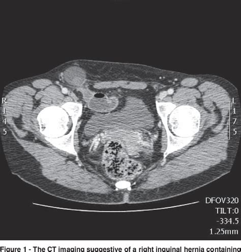 Figure From Coexisting Incarcerated Femoral And Obturator Hernia A Case Report Semantic