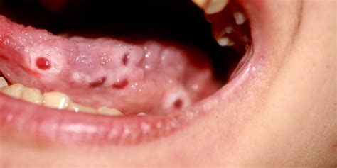 Oral herpes) and sebaceous glands that are in the wrong place as christian nordqvist describes it in an article. Canker/Cold Sores - Home