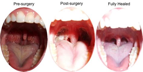 Adenoidectomy Before And After