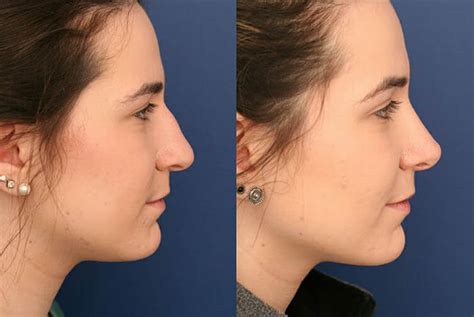 Rhinoplasty Best Cosmetic Plastic Surgeon Nose Job Cost In Iran 1290