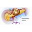 Slideshow A Visual Guide To Understanding Pancreatic Cancer