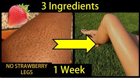 How To Get Rid Of Strawberry Legsingrown Hairs In 1 Week 3