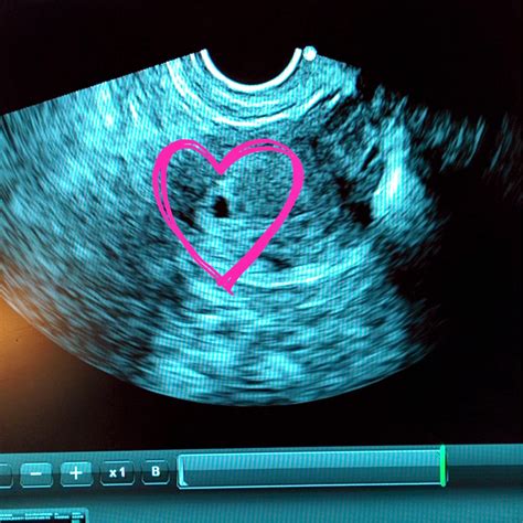 If you are 5 weeks pregnant with twins, you can see both the embryos during the scan. Hoping for Baby B: 5 week ultrasound