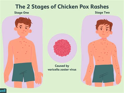 Early Stage Measles Smallpox Early Stage Measles Chicken Pox Symptoms