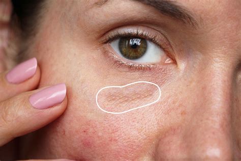 Electric Microneedle Pen Fix The Clogging Of Pores Remove Acne Dots