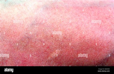 Very Hard To Sunburned Skin Stock Photo Alamy