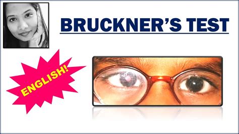 Bruckners Test English Squint Simplified Paediatric
