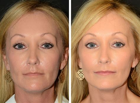 Filler Injections To Lower Face Photo Gallery