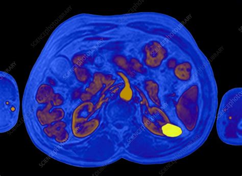 Kidney Cancer Mri Scan Stock Image C0147083 Science Photo Library