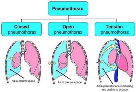 Tension Pneumothoraxwhat To Do