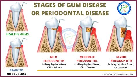 Early Signs Of Gum Disease Molars