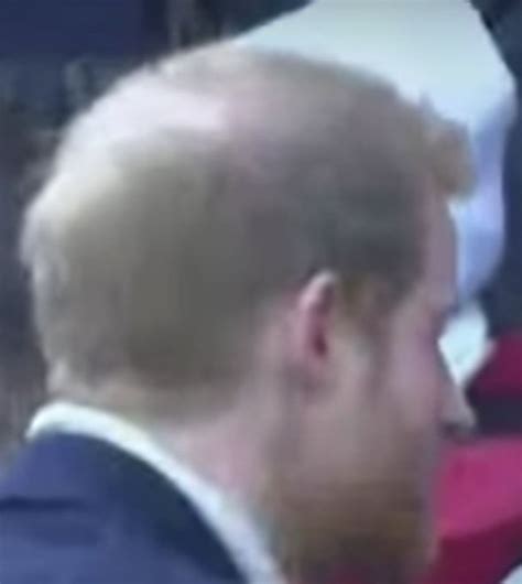 Is Prince Harry Going Bald Princes Scalp Visible As He