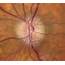Glaucomatous Optic Nerves  Sharp Focus