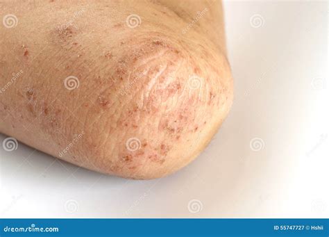 Eczema Stock Photo Image 55747727