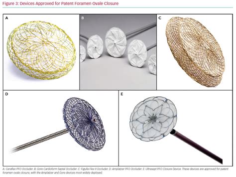 Patent Foramen Ovale Pfo Closure Procedure And Indications