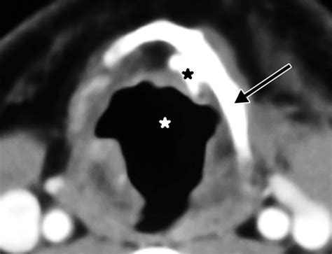 Ct Findings After Laryngectomy Radiographics