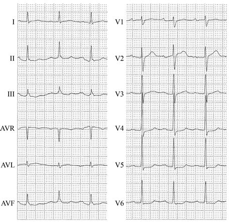 A Progressively Changing Ecg The Bmj