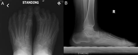 Correction Of Idiopathic Adult Hallux Varus By Tendon Transfer The
