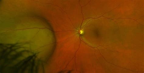 Optos Retinal Detachment Le Edgbaston Eye Clinic
